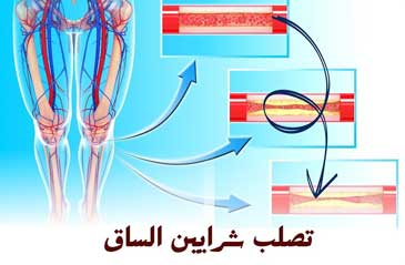 علاج تصلب شرايين الساق