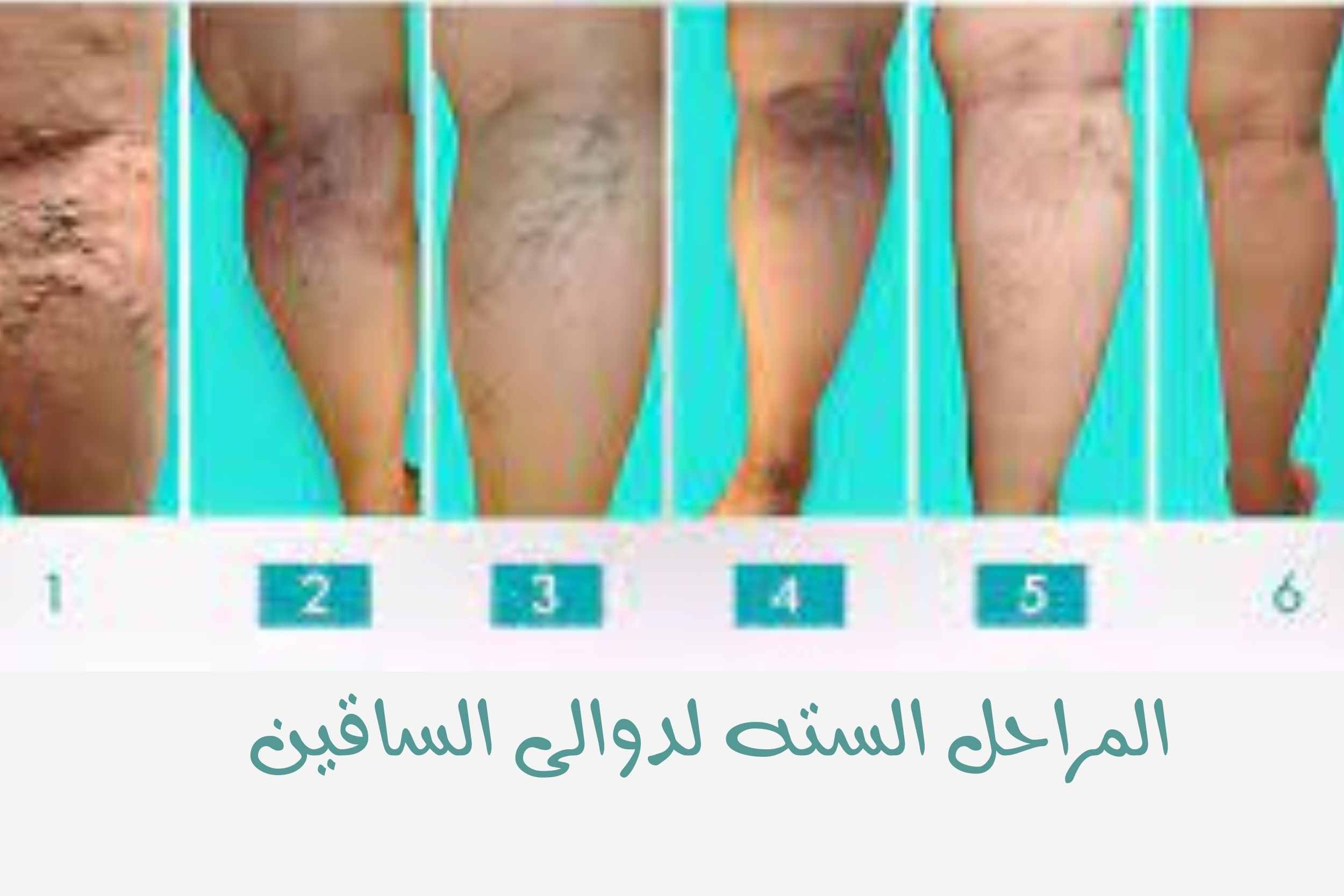 مراحل دوالى الساقين